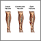 Bone fracture repair- series