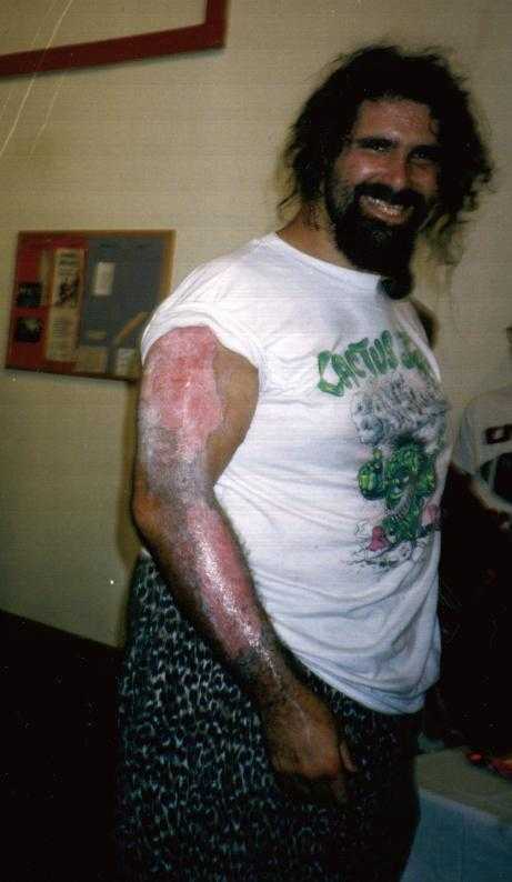 Cactus Jack and his burned arm