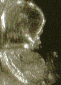 Sonogram photo taken February 28, 2002.