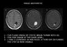 brain cystic tumor - multichannel postprocessing