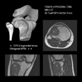 knee - tumor segmentation