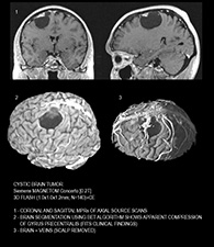 cystic brain tumor