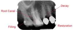 Periapical xray labelled
