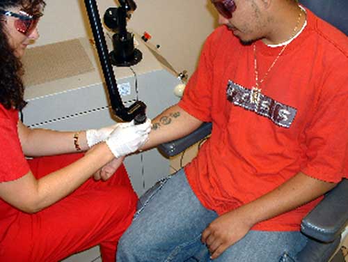  tattoos removed, free of charge through the Gang Outreach Tattoo Removal 